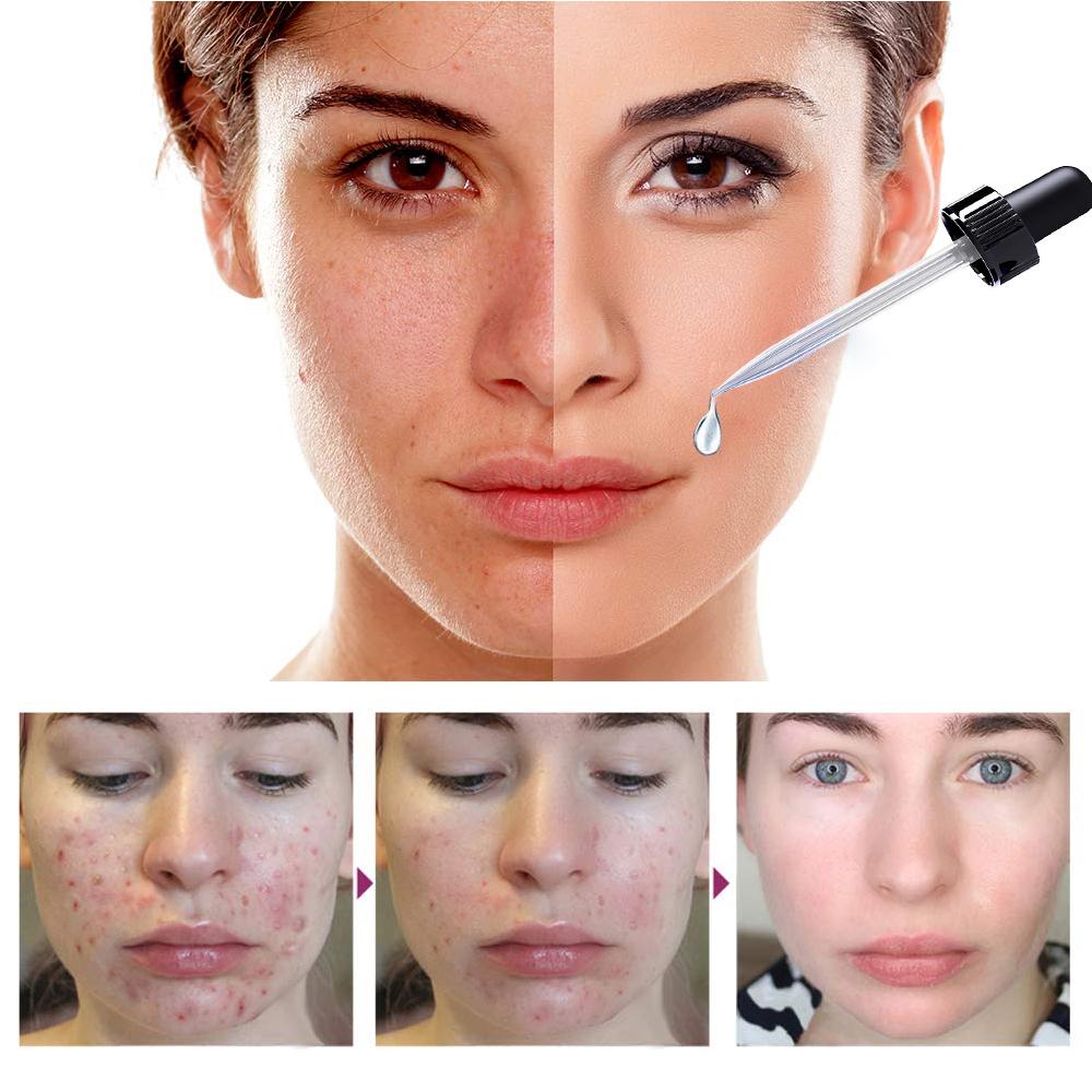 SalicylicI Acid 2% Serum Mild Peel Acne Scrs Clarifying Pores Sebum