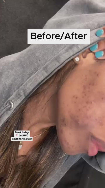 SalicylicI Acid 2% Serum Mild Peel Acne Scrs Clarifying Pores Sebum